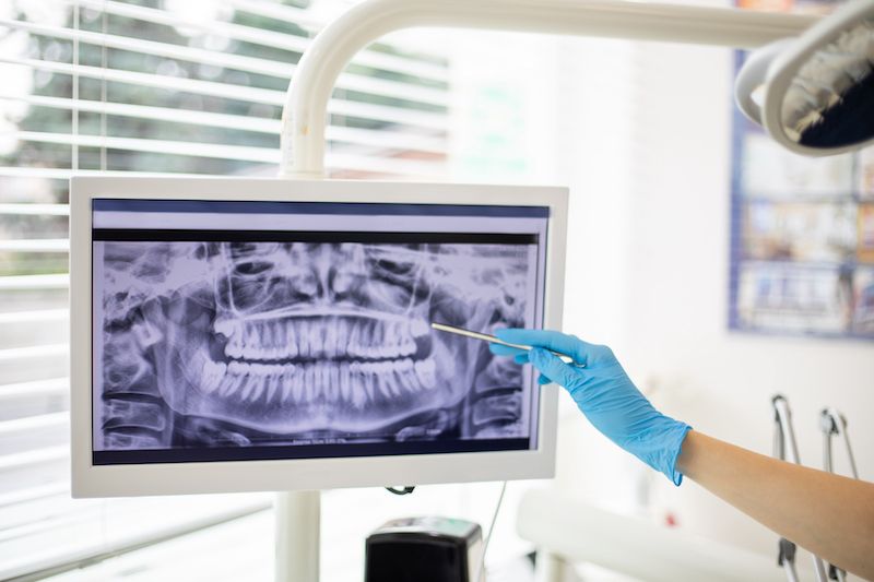Gum disease: Treatment and prevention